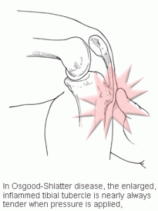 Osgood Schlatter