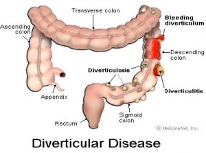 Diverticulosis pics