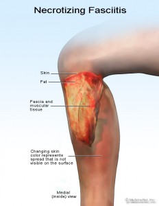 Necrotizing Fasciitis