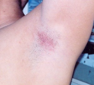underarm rash