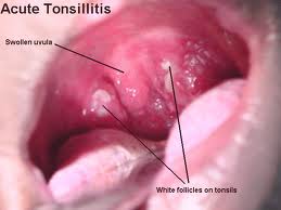 Acute Tonsillitis Pictures