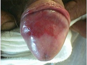 images of Balanitis