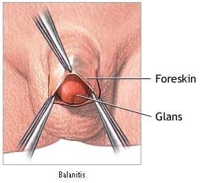 Balanitis photo