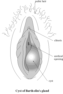 Bartholin Cyst image