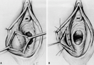 Bartholin Cyst