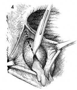 Bartholin Cyst drainage