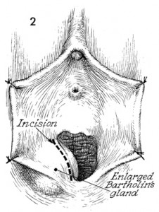 pictures of Bartholin Cyst incision