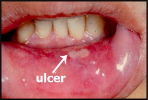 picture of canker sore
