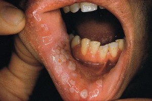 Pictures of Canker sore