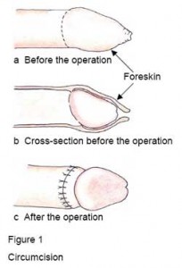 balanitis treatment