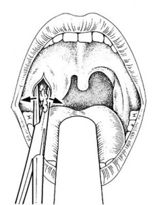 Peritonsillar Abscess photos