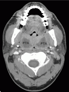 Peritonsillar Abscess image