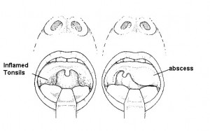 Peritonsillar Abscess picture