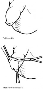 Phimosis Surgery