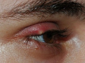 Swollen Eyelid pictures