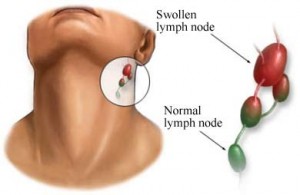 Glandular Fever in adults and children