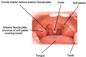 Swollen Tonsils