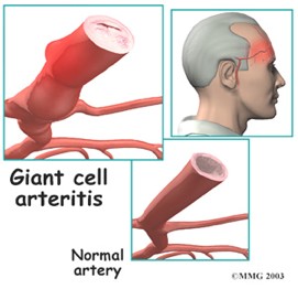 giant cell Arteritis