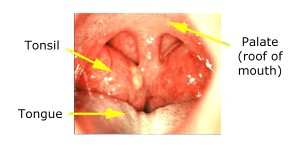 tonsil pictures