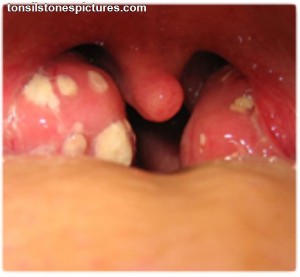 Tonsil Stones Photos