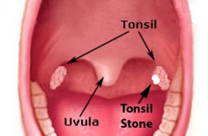 Photos of Tonsil Stones