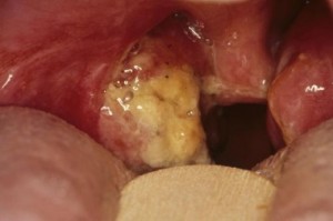 tonsil stone images