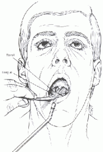 Removing Tonsil Stones