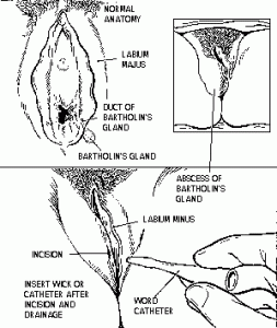 photos of Bartholin Cyst