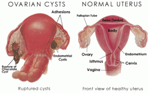 ovarian cysts pictures
