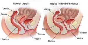 Picture of Retroverted Uterus