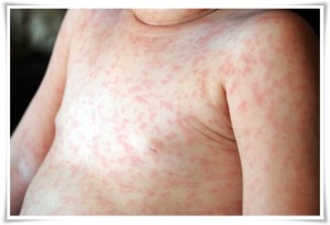 images of roseola rash