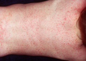 photos of roseola rash