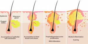 sebaceous gland pictures