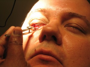 Chalazion Surgery