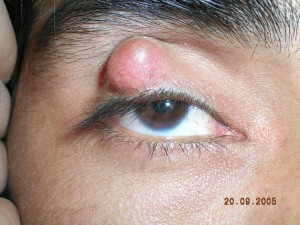 Images of Chalazion