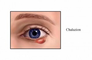 Photos of Chalazion