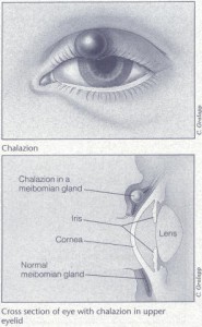 Pictures of Chalazion