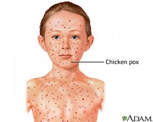 Chicken Pox Pictures