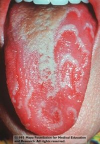 images of Geographic Tongue