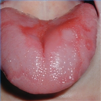 photos of Geographic Tongue
