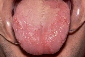 pictures of Geographic Tongue