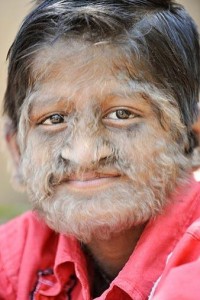 images of Hypertrichosis