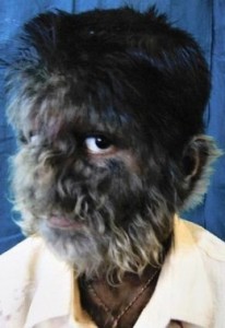 photos of Hypertrichosis