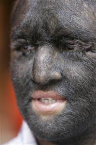 pictures of Hypertrichosis