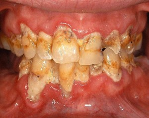 Meth Mouth pics