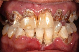 images of Meth Mouth