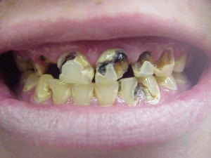 photos of Meth Mouth