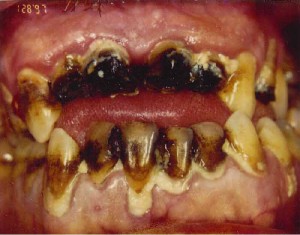 pictures of Meth Mouth