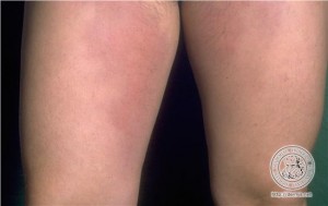 pictures of panniculitis