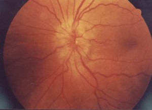 Papilledema pics